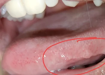 Arts waarschuwt dat ‘geschulpte tong’ teken kan zijn van zorgwekkende onderliggende aandoening