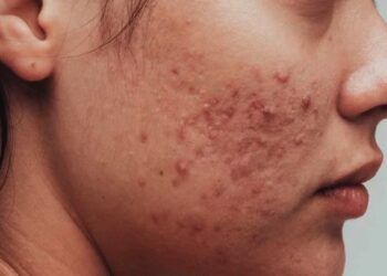 Wat!? Deze populaire shampoo is kenneljk een wondermiddel tegen puistjes en acne