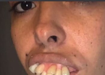 Bizar: Vrouw leeft jarenlang met onwijs slecht gebit – Kijk hoe ze er nu uitziet!